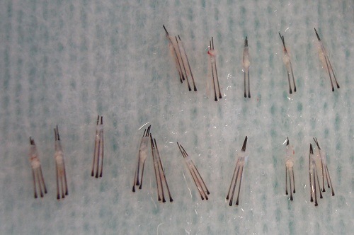 Propecia nach 5 jahren Propecia nach 5 jahren